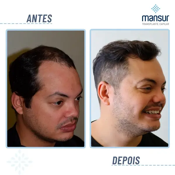 Resultado FUE — 2.700 folículos