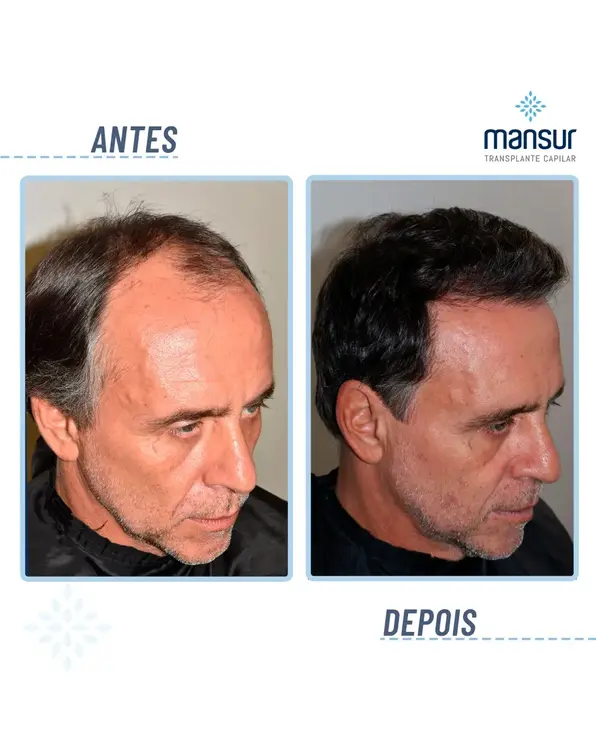 Resultado BHT — 3.300 folículos