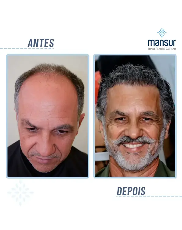 Resultado BHT — 3.100 folículos