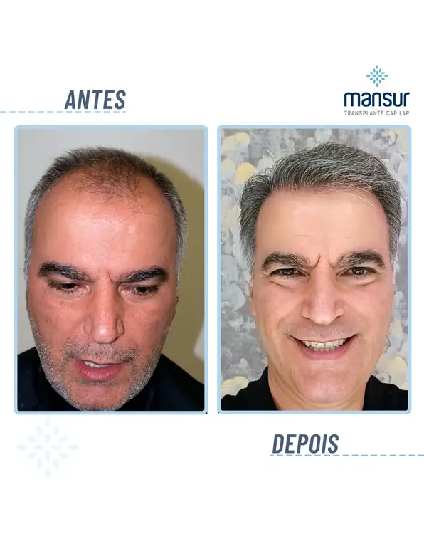 Resultado FUE — 2.400 folículos