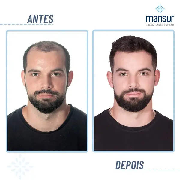 Resultado FUE+FUT — 9.500 folículos