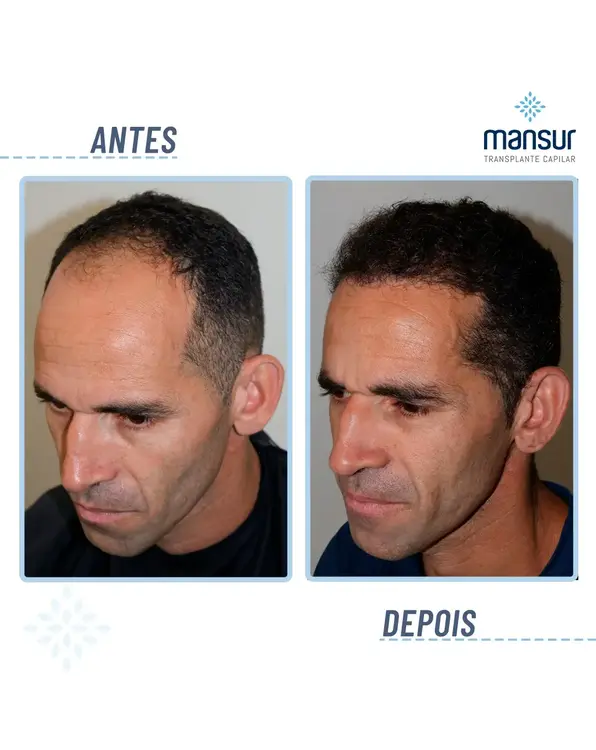 Resultado FUE — 2.600 folículos