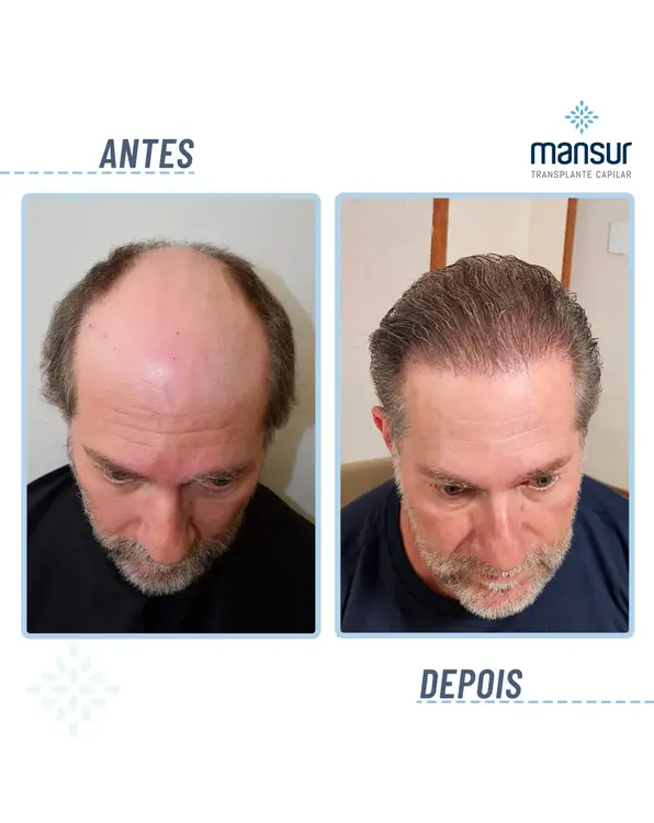 Resultado FUT — 2.800 folículos