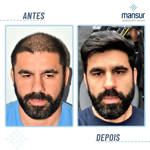 Resultado FUE — 3.700 folículos